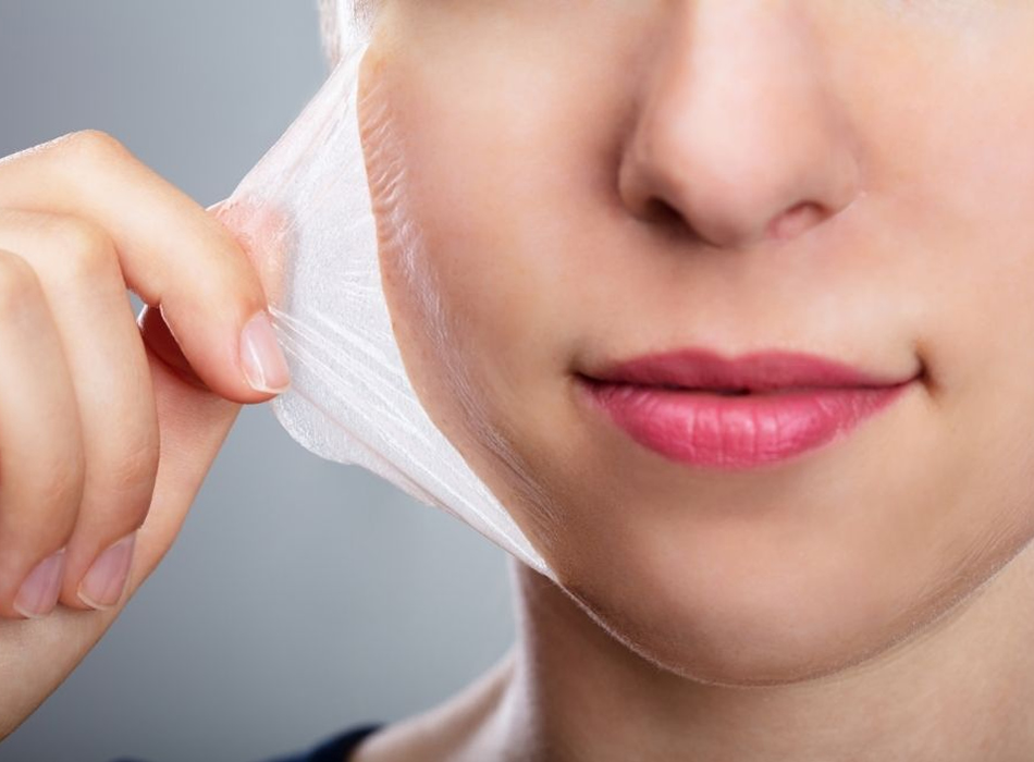 Kimyasal Peeling